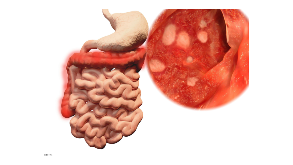 潰瘍性大腸炎の患部である大腸のイメージ写真