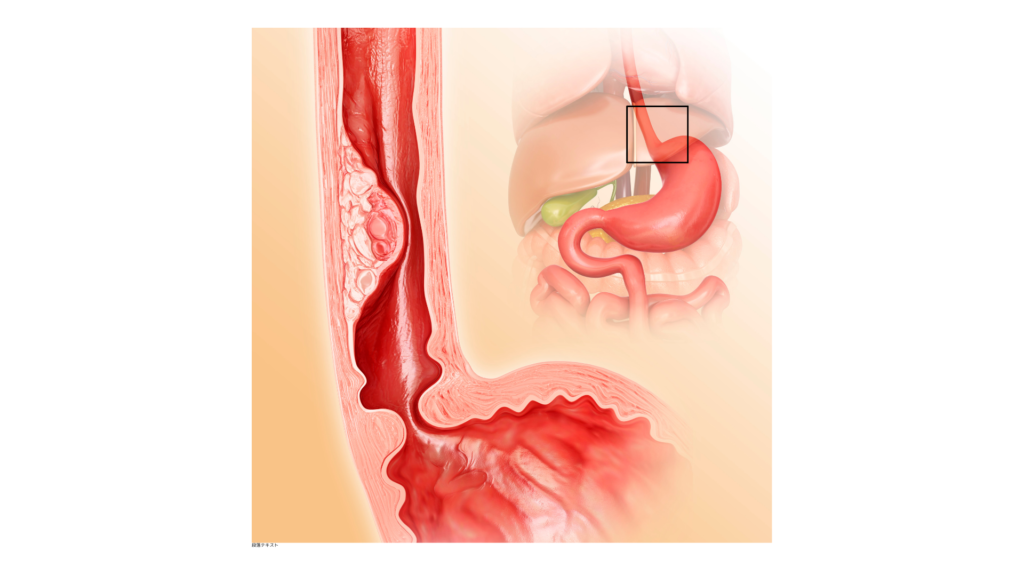 食道がんの患部である、食道に腫瘍ができたイメージ写真